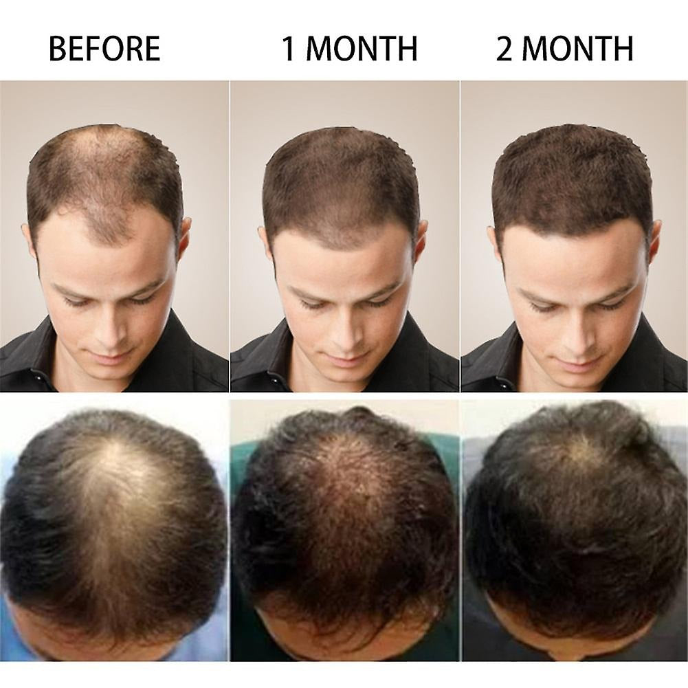 Anti Hair Loss Serum 2 In 1 Natural Hair Fall Serum Ginger And Tocopherol Hair Growth Essence Oil Hair Care Serum | Hair Loss Treatment For Men & Women |