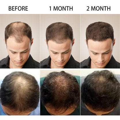 Anti Hair Loss Serum 2 In 1 Natural Hair Fall Serum Ginger And Tocopherol Hair Growth Essence Oil Hair Care Serum | Hair Loss Treatment For Men & Women |